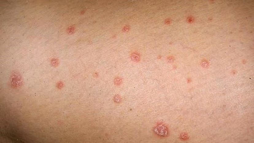 Điều trị giang mai ở Linh Đàm: Địa chỉ uy tín giúp chẩn đoán và điều trị kịp thời