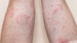 Điều trị giang mai ở Đại Từ tại đâu uy tín?