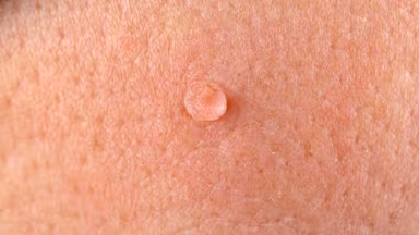 Đốt sùi mào gà ở Thanh Trì: Nên điều trị khi nào và ở đâu uy tín?