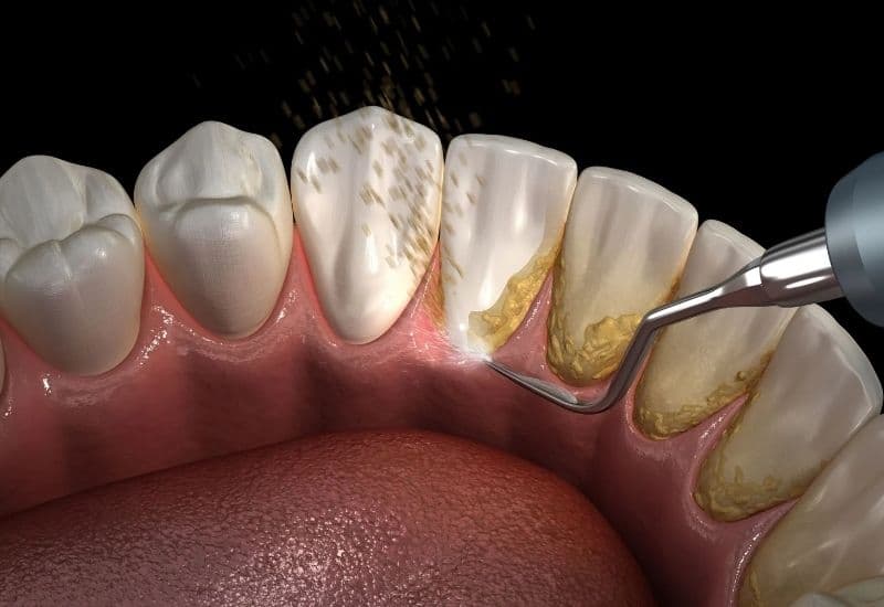 Vì sao lấy cao răng xong bị ê buốt?