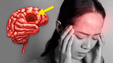 Mổ u não ác tính/lành tính sống được bao lâu?