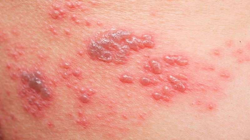 Bác sĩ giỏi chữa mụn rộp sinh dục