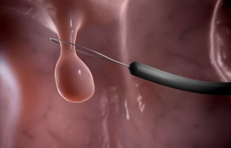 Polyp cổ tử cung bao lâu thành ung thư?