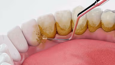 Có phải răng bị thưa sau khi lấy cao răng?