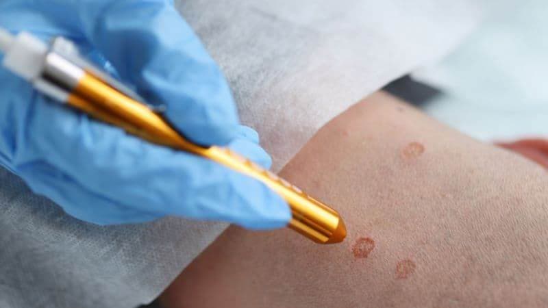 Chi phí điều trị sùi mào gà