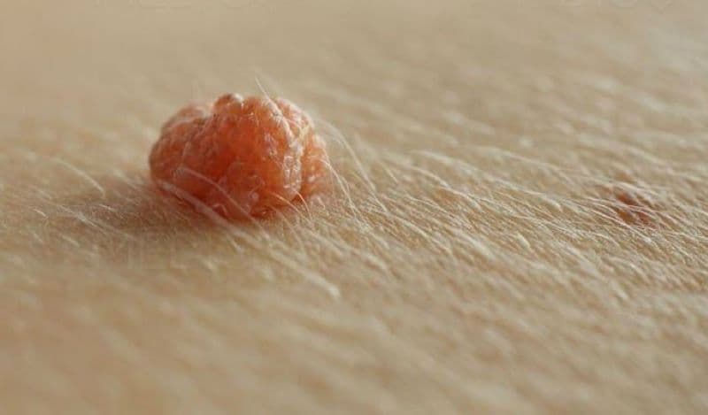 Khám sùi mào gà ở Hoàng Mai: Địa chỉ uy tín