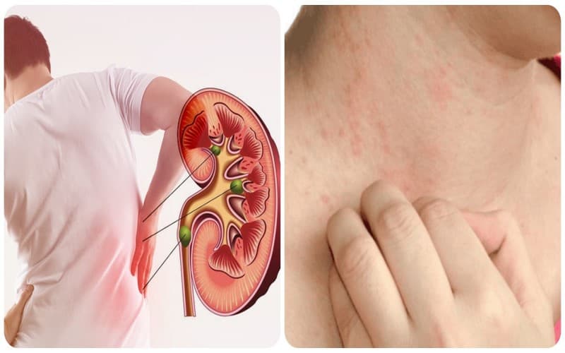 suy thận giai đoạn 2 chữa được không