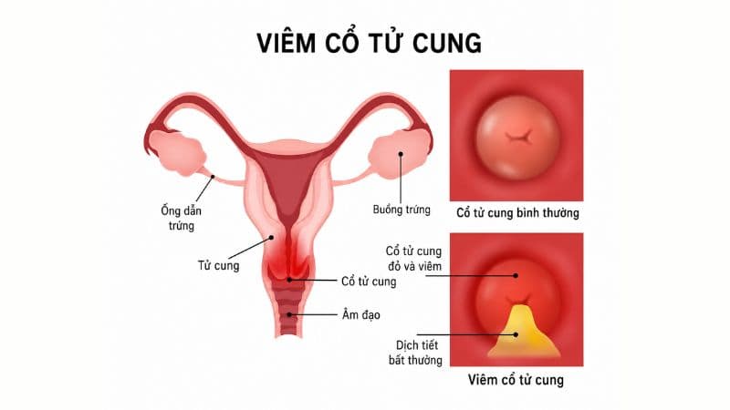 tại sao bị viêm cổ tử cung