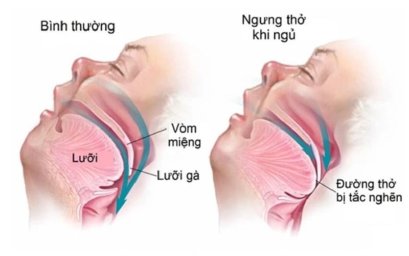 tại sao ngủ ngáy to