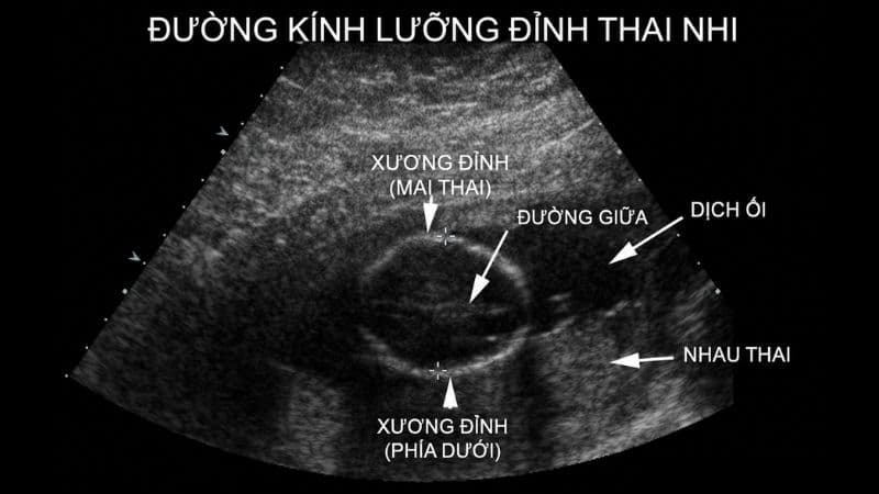 Thai 34 tuần đường kính lưỡng đỉnh bao nhiêu?