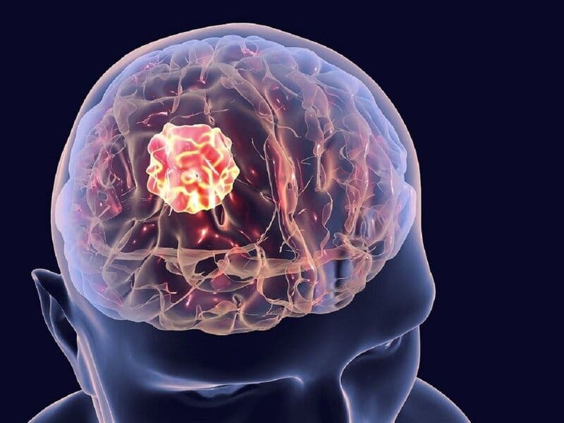 thang điểm ICH trong xuất huyết não