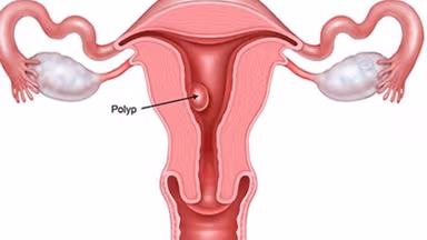Bị polyp tử cung có nguy hiểm không và câu trả lời