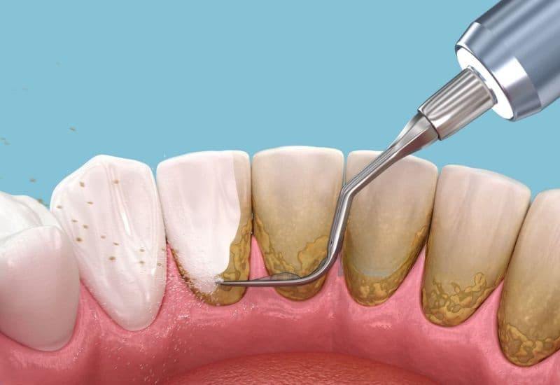 Các thuốc bôi chữa tụt lợi hiệu quả