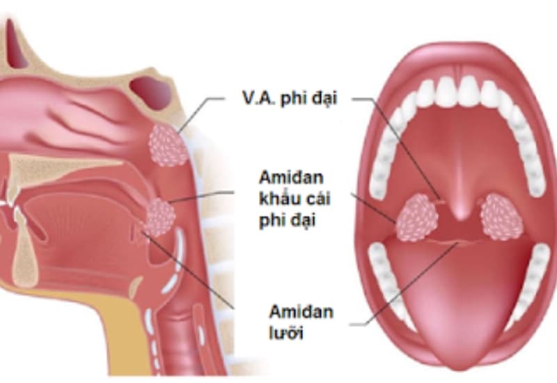 trẻ sơ sinh ngủ ngáy là bệnh gì