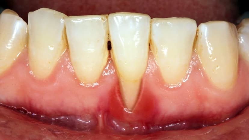 Bị tụt lợi có hồi phục được không?