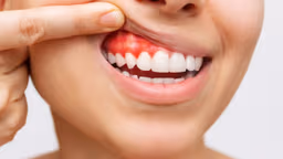 Viêm lợi có tự khỏi được không?