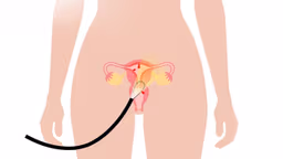Đốt polyp tử cung giá bao nhiêu và bảng giá chi tiết mới nhất