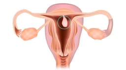 Cắt polyp tử cung cần nghỉ ngơi bao lâu để hồi phục hoàn toàn?