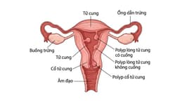 Cắt Polyp Cổ Tử Cung Giá Bao Nhiêu? Chi Phí Mới Nhất
