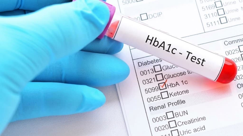 HbA1c giúp theo dõi hiệu quả điều trị tiểu đường