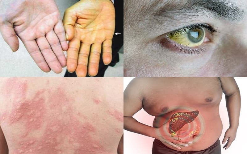 Bệnh gan có thể diễn tiến âm thầm nhưng gây tổn thương nghiêm trọng nếu không được phát hiện và kiểm soát sớm