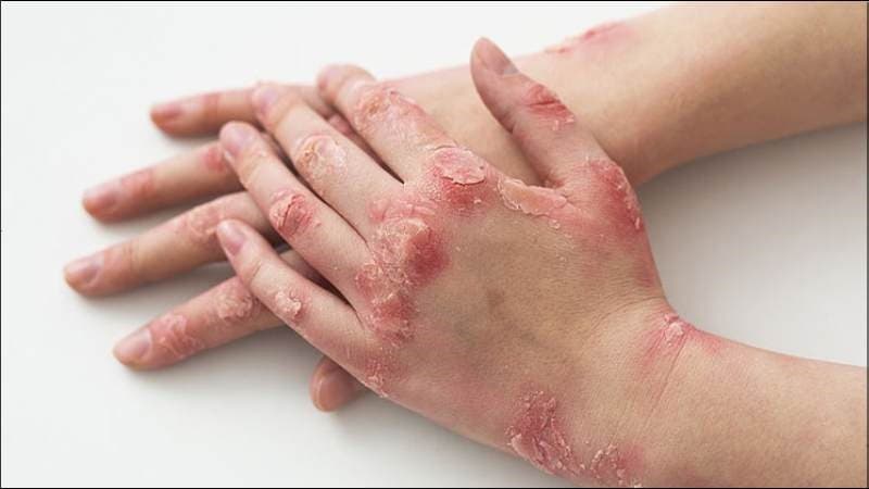 Bác sĩ khuyến cáo không bôi thuốc 7 màu lên vùng da bị xước, các vết thương hở sâu