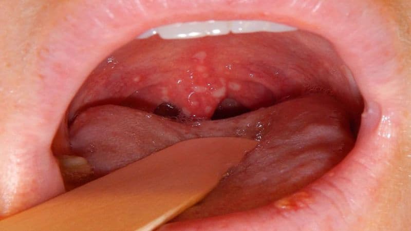 Nhiều biểu hiện ở vùng tai, mũi, họng khá giống nhau nhưng có thể xuất phát từ những nguyên nhân khác nhau