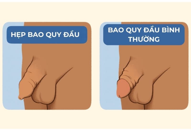 Bao quy đầu vẫn không thể tuột xuống khi trẻ lớn