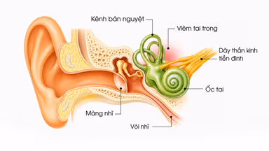 Rối loạn tiền đình: Nguyên nhân và cách điều trị