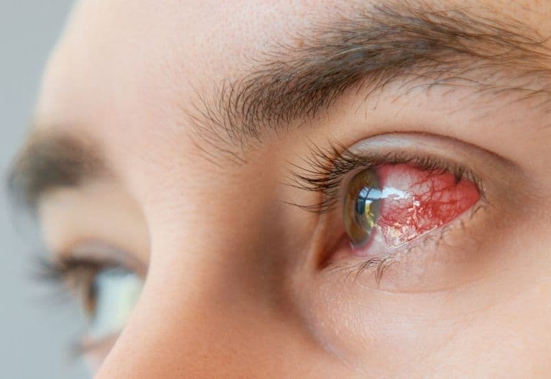 Biểu hiện của đau mắt đỏ là gì?