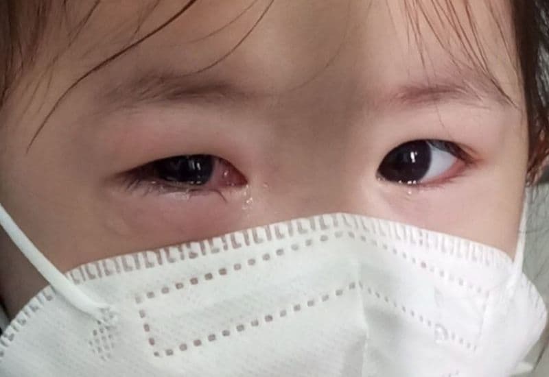 Bé bị đau mắt đỏ cần chăm sóc như thế nào?