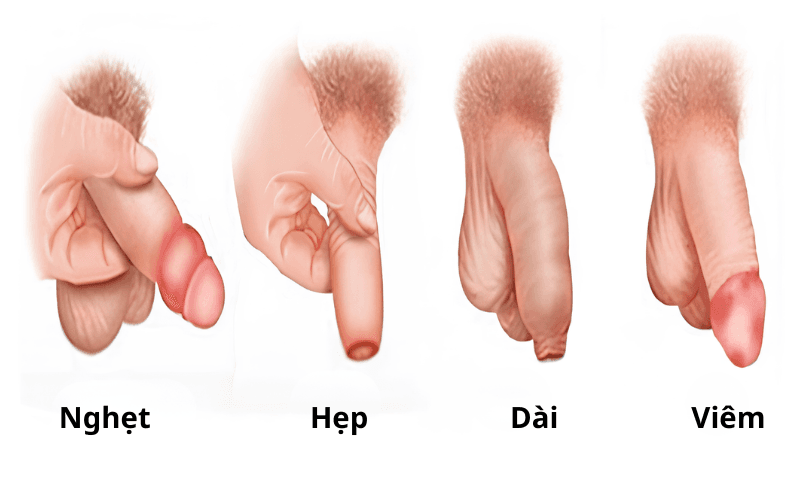 cắt bao quy đầu bao lâu thì lành