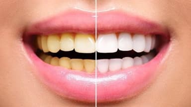 Cách làm trắng răng an toàn, hiệu quả dành cho răng ố vàng