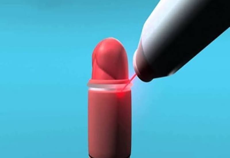 Cắt bao quy đầu bằng laser ít đau, ít chảy máu, thời gian thực hiện ngắn và nguy cơ nhiễm trùng thấp