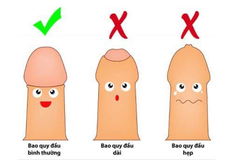 Cắt bao quy đầu có thể được chỉ định khi dài, hẹp bao quy đầu gây khó vệ sinh hoặc viêm nhiễm tái phát