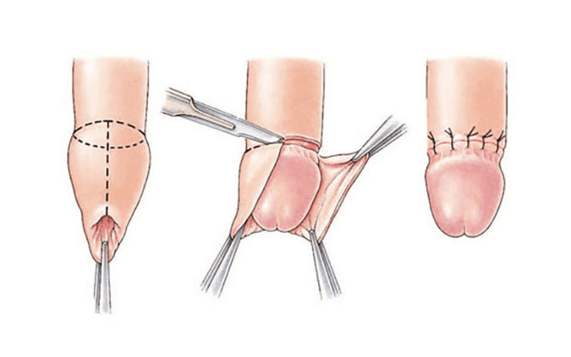 Cắt bao quy đầu không làm thay đổi kích thước dương vật