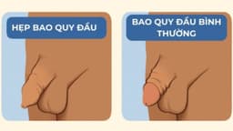 Cắt bao quy đầu hẹp: Giải pháp toàn diện cho sức khỏe nam giới