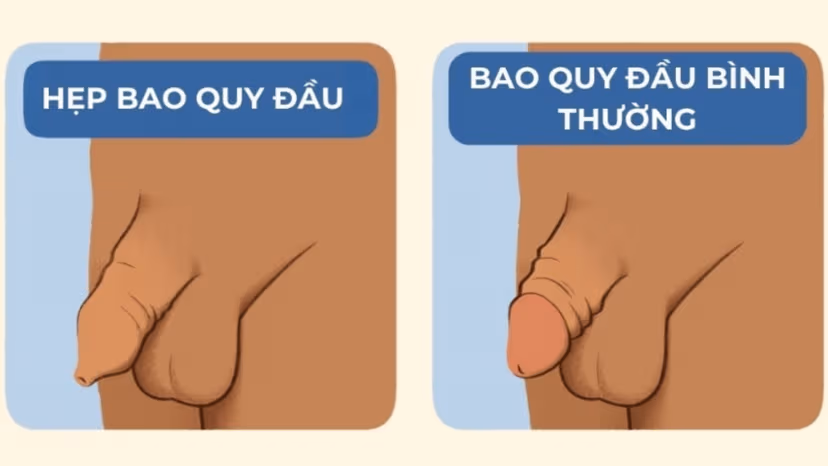 Cắt bao quy đầu hẹp: Giải pháp toàn diện cho sức khỏe nam giới
