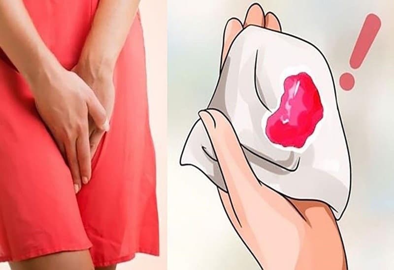 Ra máu âm đạo nhẹ trong những ngày đầu có thể xuất hiện khi vùng cổ tử cung đang hồi phục.