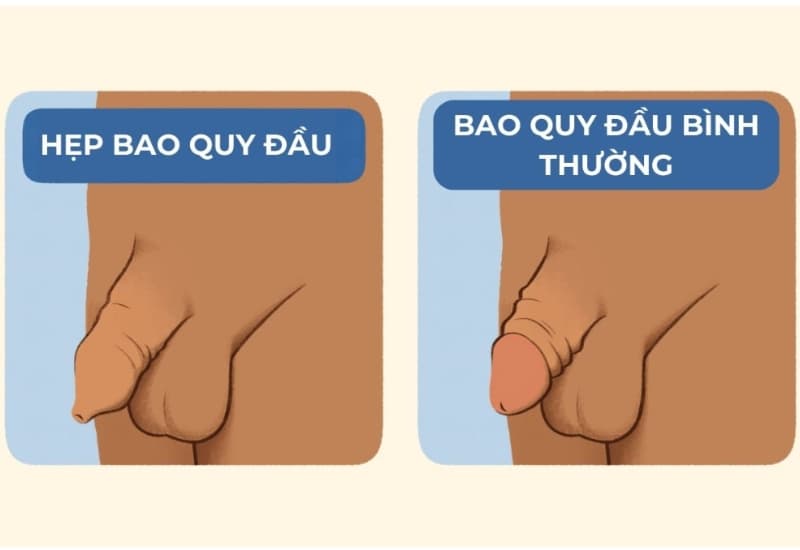 Hẹp bao quy đầu gây khó bộc lộ quy đầu, có thể ảnh hưởng đến vệ sinh và làm tăng nguy cơ viêm nhiễm