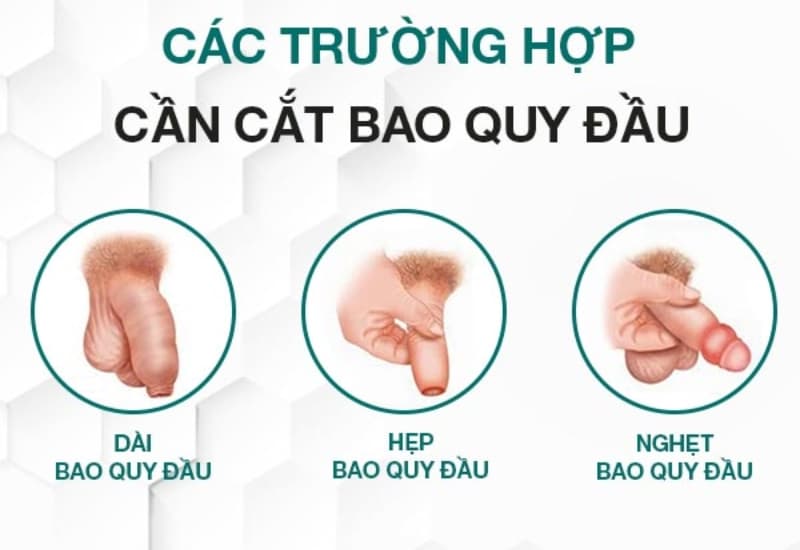 Hẹp, dài hoặc nghẹt bao quy đầu là những tình trạng cần được bác sĩ thăm khám và đánh giá hướng can thiệp phù hợp