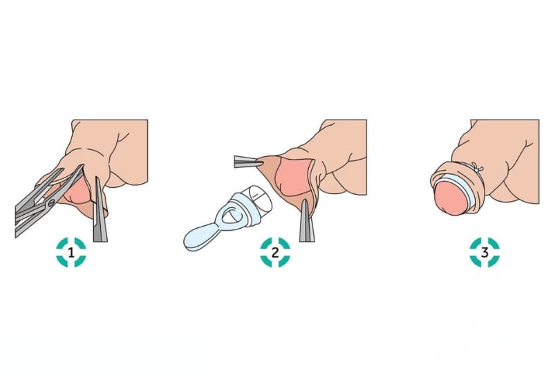 Mỗi phương pháp cắt bao quy đầu có ưu điểm riêng, bác sĩ sẽ tư vấn dựa trên tình trạng cụ thể của người bệnh.