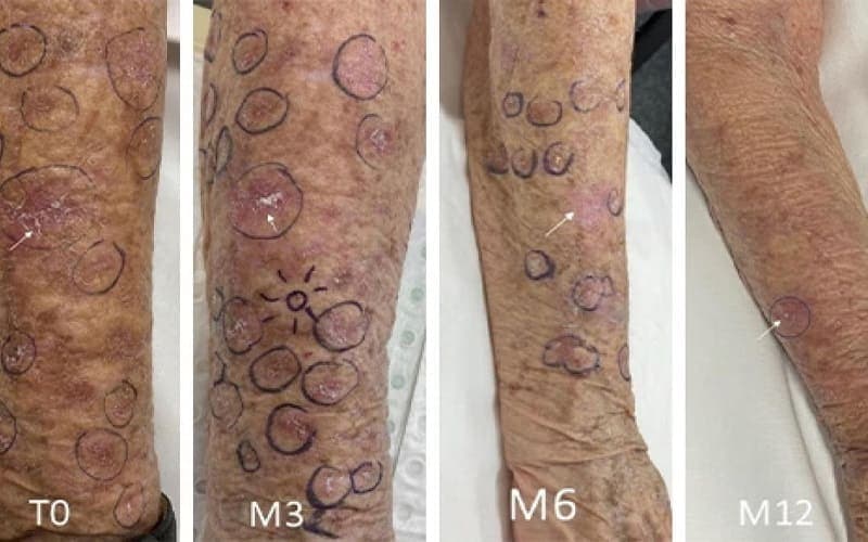 Mức độ đáp ứng điều trị của bệnh nhân ung thư da qua 1 năm