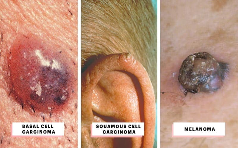 Phân loại ung thư da