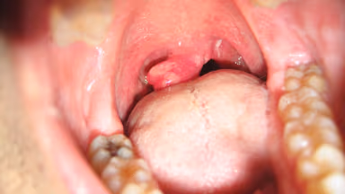 Cắt lưỡi gà có sao không và lúc nào cần thiết, các biến chứng tiềm ẩn
