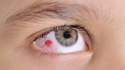 Trầy xước giác mạc: Nguyên nhân, triệu chứng, điều trị
