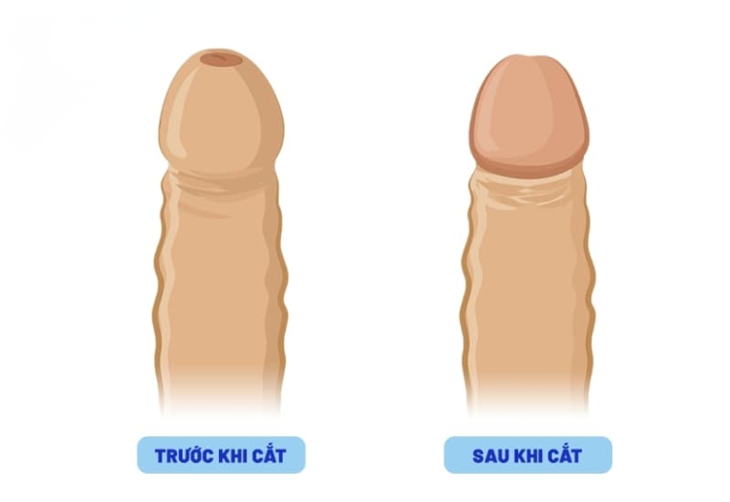 Trước và sau khi cắt bao quy đầu