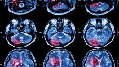 Ung thư não có nguy hiểm không? Dấu hiệu và cách điều trị?