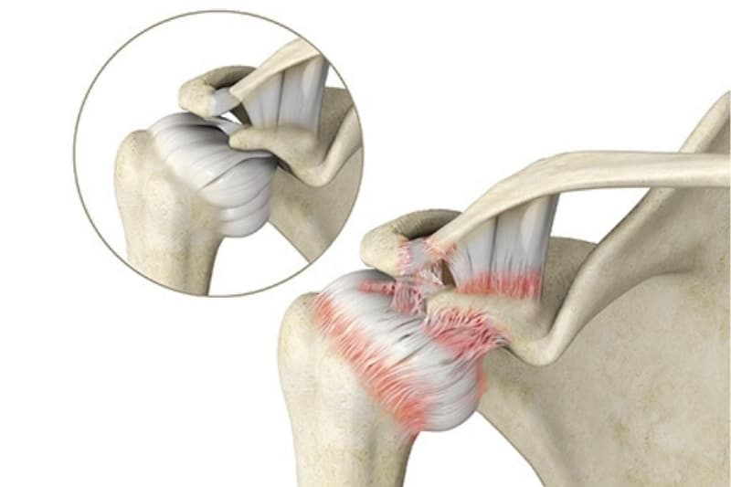 Viêm dính bao khớp khiến bao khớp vai bị dày, co thắt, gây ra tình trạng đông cứng khớp vai
