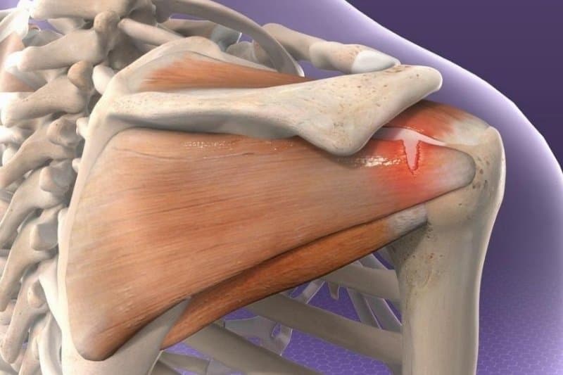 Khi nhóm gân chóp xoay bị cọ xát, kích ứng hoặc tổn thương mạn tính, phản ứng viêm sẽ bùng phát và ảnh hưởng trực tiếp đến khả năng vận động
